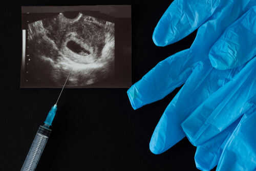 Ultrasound image syringe and blue gloves on black background