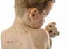 Measles Explosion — Who Fumbled The Safeguards? Child with red spots on back holding a teddy bear