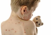 Measles Explosion — Who Fumbled The Safeguards? Child with red spots on back holding a teddy bear