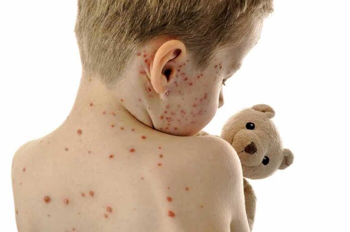 shutterstock_1082052893 Child with red spots on back holding a teddy bear