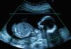 Fetal ultrasound scan image