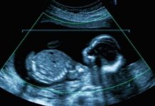Fetal ultrasound scan image